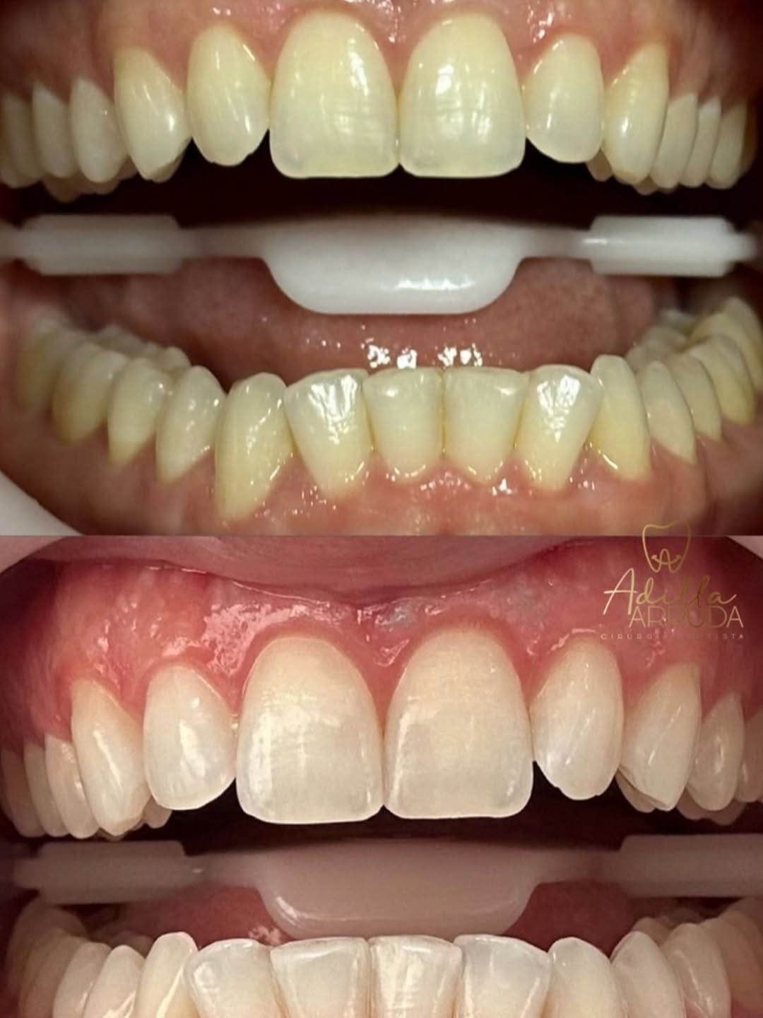 Facetas em Resina (antes e depois)